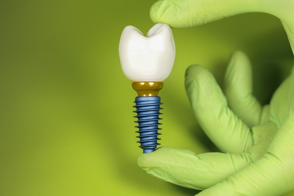 How Long Do Dental Implants Really Last?