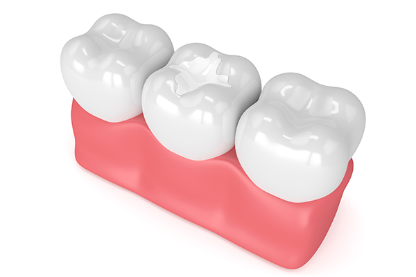 How A General Dentist Uses Dental Fillings For Tooth Decay