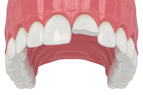 Seeing a General Dentist to Repair an Injured Tooth from Bagnall Family Dentistry in Andover, MA